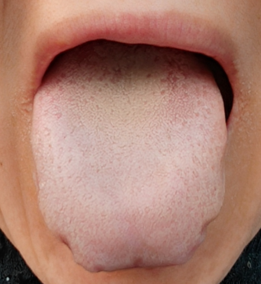 舌苔又白又厚的5种原因，5个方法教你对症调，附中成药