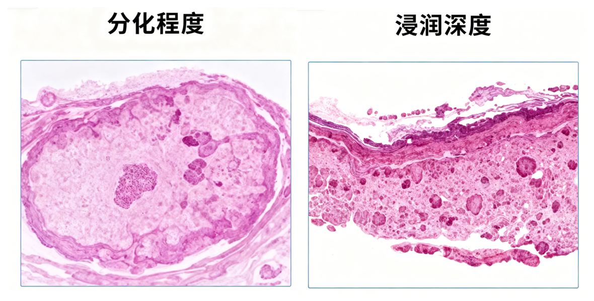 别过分担心！病理报告里这5个关键词，提示癌症复发转移风险低