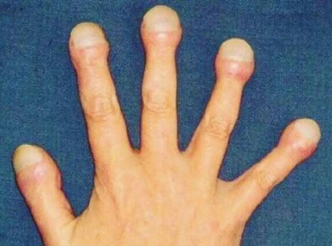 很多肺癌患者确诊前，咳都没咳过！这6种非典型信号更需警惕