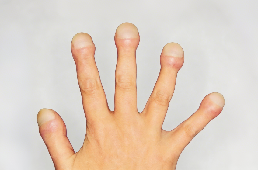 不是在吓唬大家！手指有这种表现，也小心是肺癌